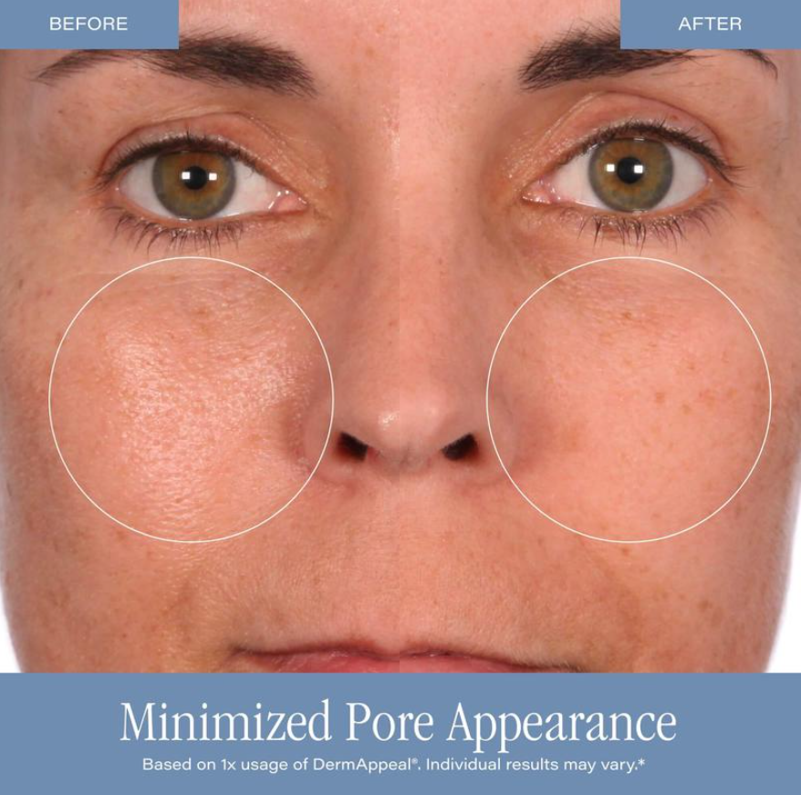 Cosmetics DermAppeal Microdermabrasion BeautyTreatment w/ V5 Crystal Technology Facial Exfoliate Tube - Powerful Microdermabrasion Skincare Treatment for All Skin Types Brightening Exfoliating Moisturizing Chemical Exfoliant