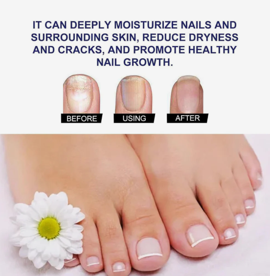 Ginger Nail Treatment Nail Support Nail Care