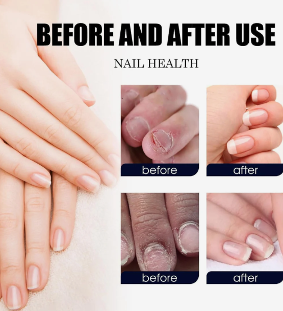 Ginger Nail Treatment Nail Support Nail Care