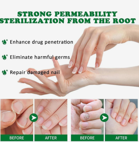 Ginger Nail Treatment Nail Support Nail Care
