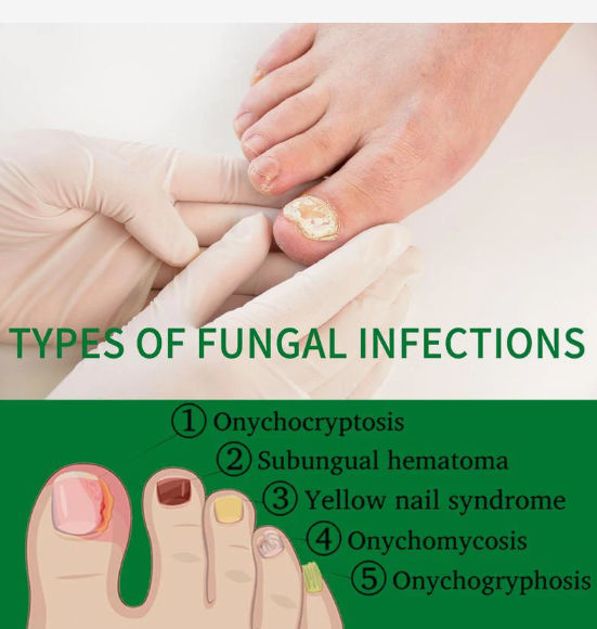 Ginger Nail Treatment Nail Support Nail Care